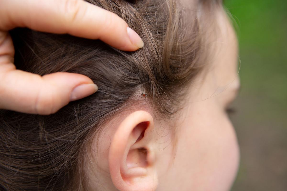 Großansicht: Ein Kind wird am Kopf auf Zeckenbisse untersucht. Überhalb des rechten Ohrs hat sich unter ihren Haaren eine Zecke eingebissen.