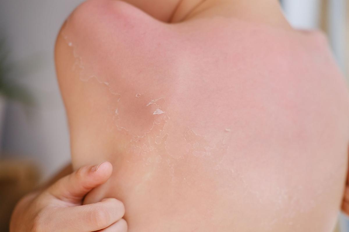 Großansicht: Rücken eines Kindes mit Sonnenbrand. Die Haut schält sich.